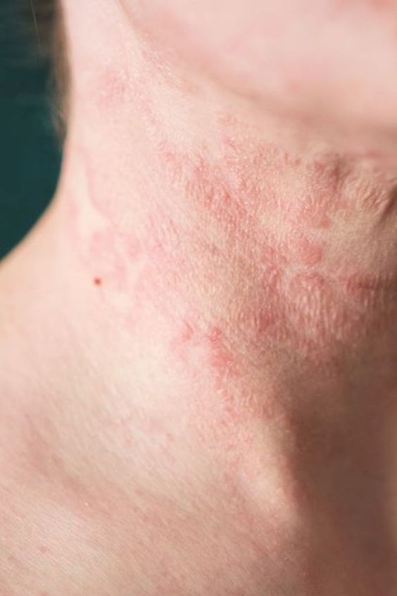 Acute Dyshidrotic Eczema: Causes, Symptoms, and Treatment